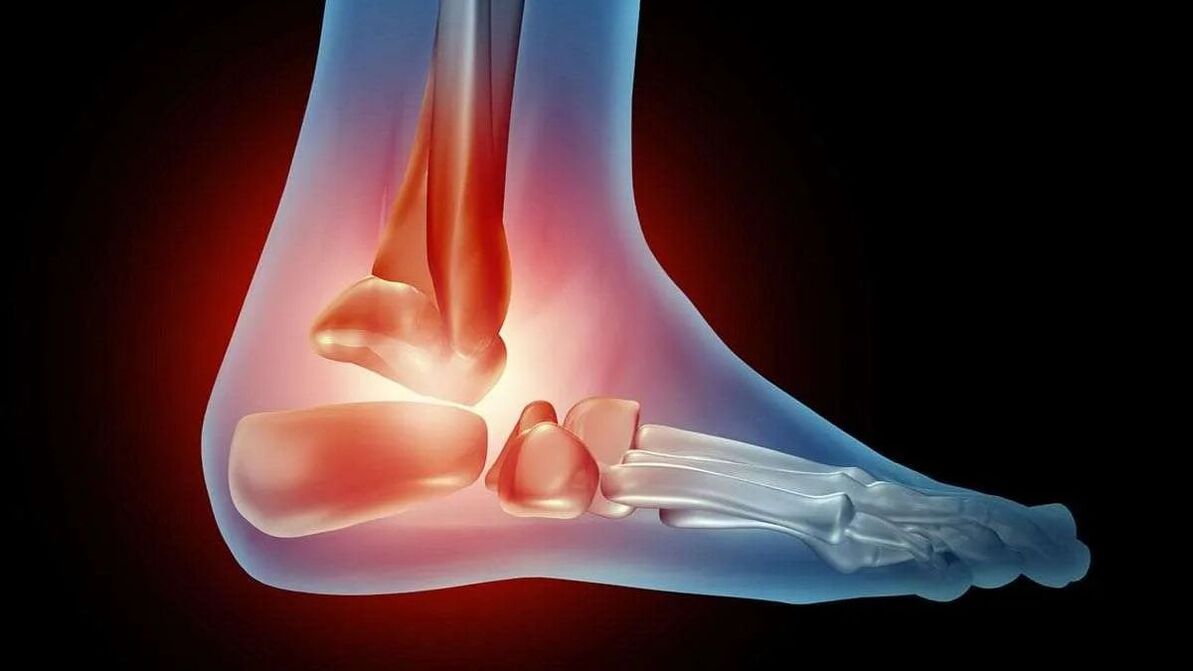 Diagrami i artrozës së kyçit të këmbës