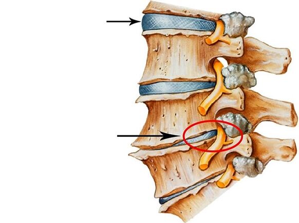 Disordersrregullimet në disqet intervertebrale